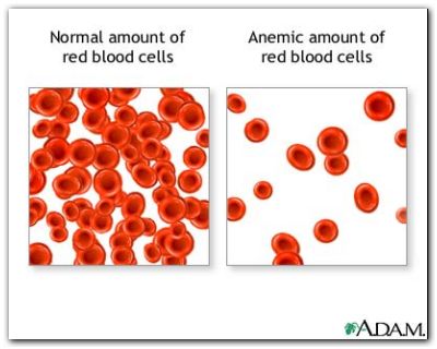 anemia_red_blood_cells anemia_red_blood_cells