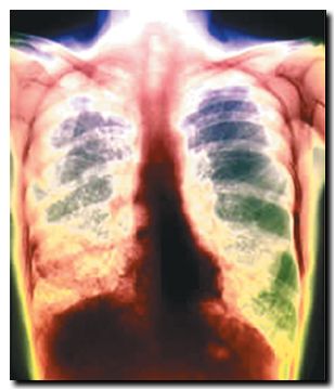 tuberculosis_01